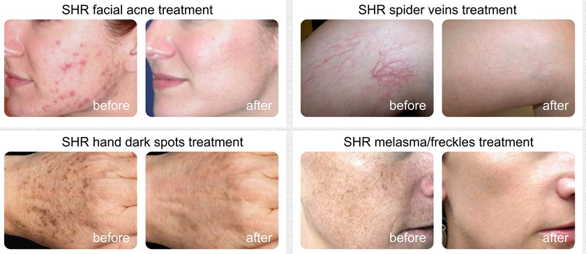 In-motion Technology Ipl Shr machine