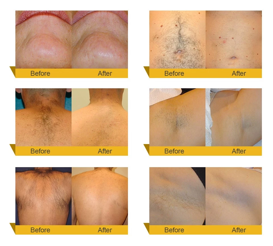 3 Wavelengths 755 808 1064 Nm Diode Laser Hair Removal Machine 3 Wavelengths 755 808 1064 Nm Diode Laser Hair Removal Machine
