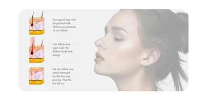 FDA Membersihkan Pembuangan Bulu Laser Diod Gabungan Gentian Pertama Dunia Me...